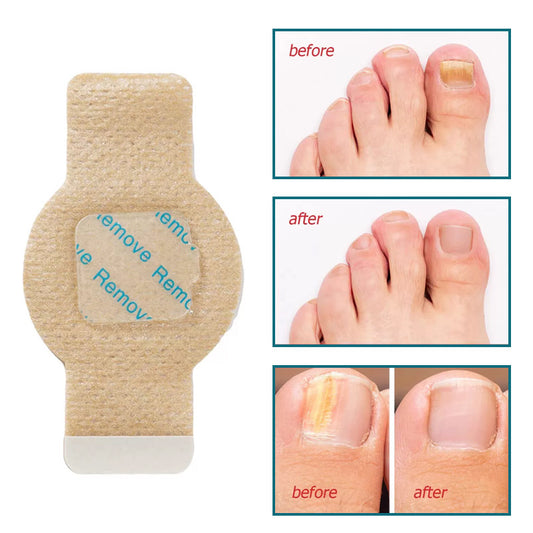 Hydrogel Nail Repair Patches for Toenails
